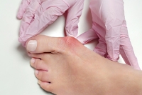 Bunions and Foot Stretches