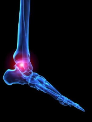 What Shoes Should I Wear if I Have Arthritis?
