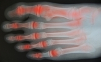 Effective Prevention Methods for Arthritic Feet