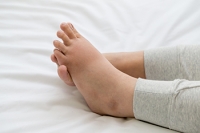 Swollen Feet Are Common During Pregnancy