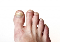 Is Your Toenail Fungus Dying?
